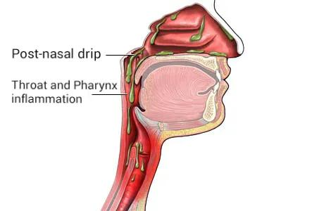What treatments are recommended when post nasal drip cough is caused by acid reflux?