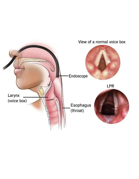 Why Does Acid Reflux Cause a Sore Throat and How Can You Tell the Difference?