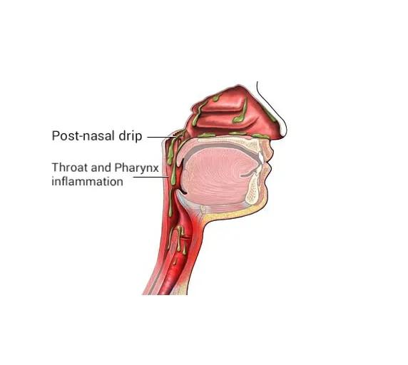 How Long Does Post Nasal Cough Last and Which Treatments Help Fastest?